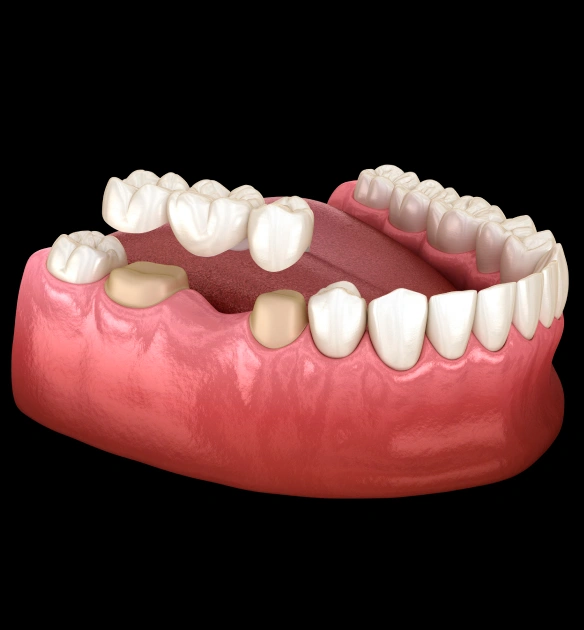 3D dental model showing tooth implants and prosthetic bridge on pink gum base.