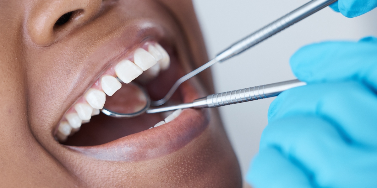 How to Fix Gapped Teeth: 5 Ways With Cosmetic Dentistry